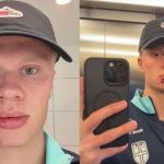 Erling Haaland dengan ekspresi serius, sedikit luka di bibir, berdiri di depan bus tim Manchester City