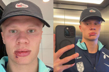 Erling Haaland dengan ekspresi serius, sedikit luka di bibir, berdiri di depan bus tim Manchester City