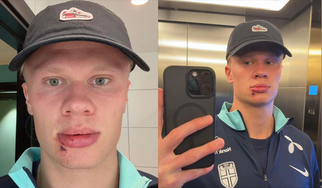 Erling Haaland dengan ekspresi serius, sedikit luka di bibir, berdiri di depan bus tim Manchester City